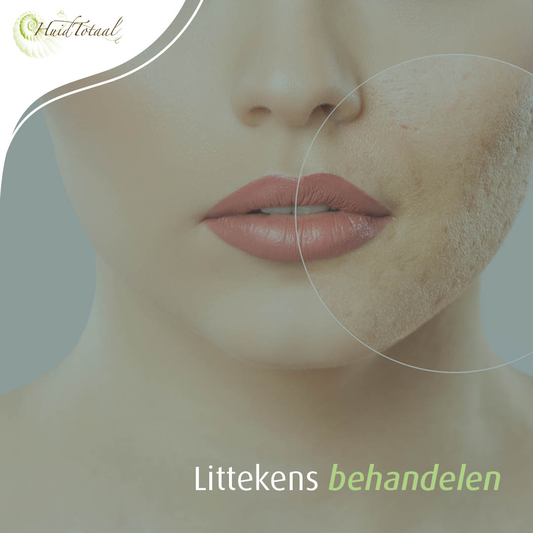 Wat kun je doen bij littekens? 